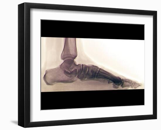 Flat Foot, X-ray-ZEPHYR-Framed Photographic Print