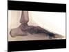 Flat Foot, X-ray-ZEPHYR-Mounted Photographic Print
