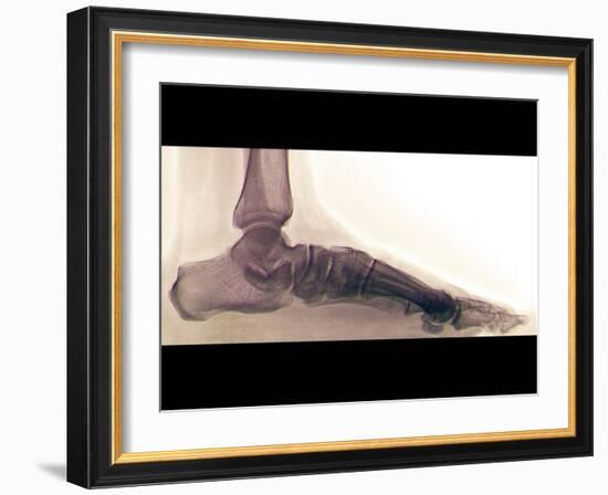 Flat Foot, X-ray-ZEPHYR-Framed Photographic Print