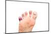 Foot Problems, Broken Toe and Calluses-soupstock-Mounted Photographic Print