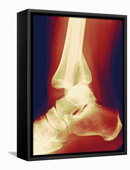 Fractured Ankle, X-ray-Miriam Maslo-Framed Premier Image Canvas