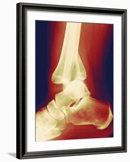 Fractured Ankle, X-ray-Miriam Maslo-Framed Photographic Print