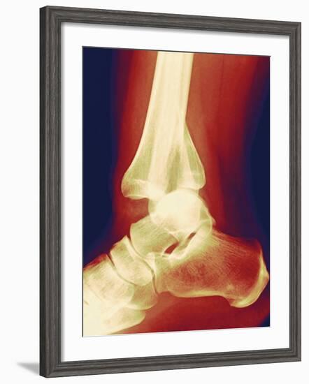 Fractured Ankle, X-ray-Miriam Maslo-Framed Photographic Print