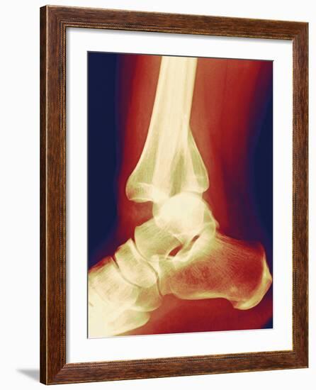 Fractured Ankle, X-ray-Miriam Maslo-Framed Photographic Print