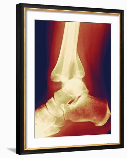 Fractured Ankle, X-ray-Miriam Maslo-Framed Photographic Print