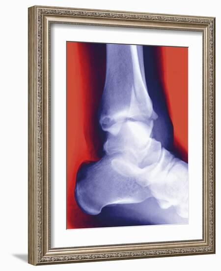 Fractured Ankle, X-ray-Miriam Maslo-Framed Photographic Print