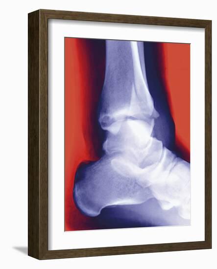 Fractured Ankle, X-ray-Miriam Maslo-Framed Photographic Print