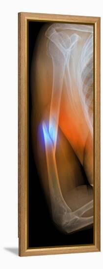 Fractured Arm, X-ray-Du Cane Medical-Framed Premier Image Canvas