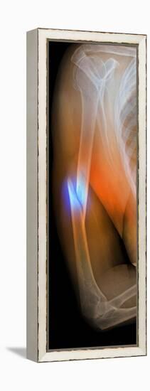 Fractured Arm, X-ray-Du Cane Medical-Framed Premier Image Canvas