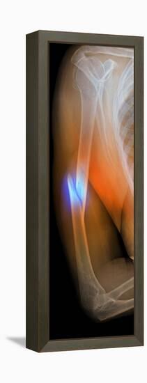 Fractured Arm, X-ray-Du Cane Medical-Framed Premier Image Canvas