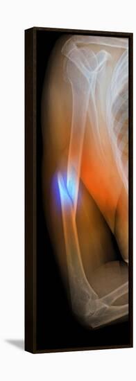 Fractured Arm, X-ray-Du Cane Medical-Framed Premier Image Canvas