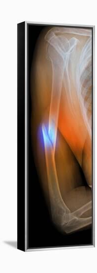 Fractured Arm, X-ray-Du Cane Medical-Framed Premier Image Canvas