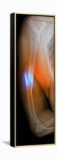 Fractured Arm, X-ray-Du Cane Medical-Framed Premier Image Canvas