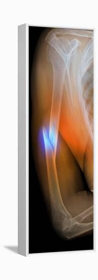 Fractured Arm, X-ray-Du Cane Medical-Framed Premier Image Canvas