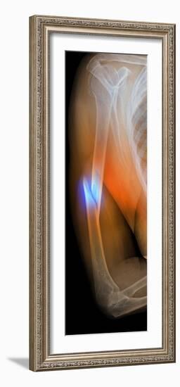 Fractured Arm, X-ray-Du Cane Medical-Framed Photographic Print