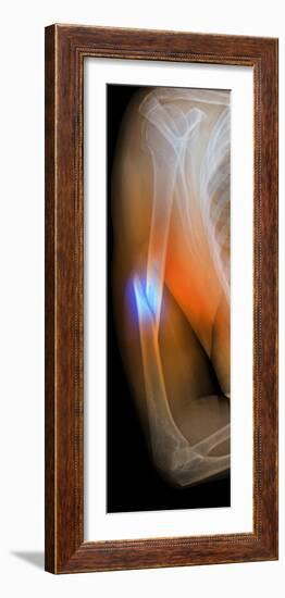 Fractured Arm, X-ray-Du Cane Medical-Framed Photographic Print
