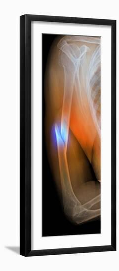 Fractured Arm, X-ray-Du Cane Medical-Framed Photographic Print