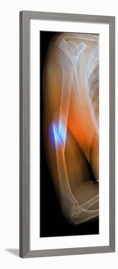 Fractured Arm, X-ray-Du Cane Medical-Framed Photographic Print