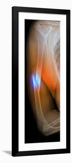 Fractured Arm, X-ray-Du Cane Medical-Framed Photographic Print