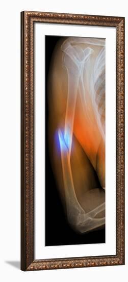 Fractured Arm, X-ray-Du Cane Medical-Framed Photographic Print