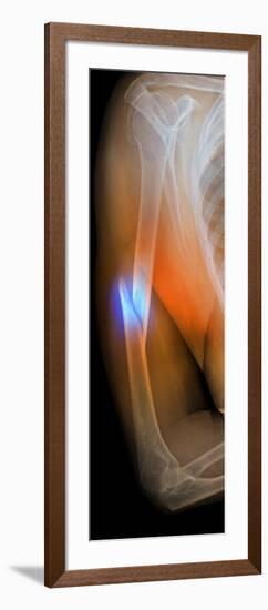 Fractured Arm, X-ray-Du Cane Medical-Framed Photographic Print