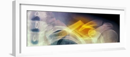 Fractured Collar Bone, X-ray-Du Cane Medical-Framed Photographic Print