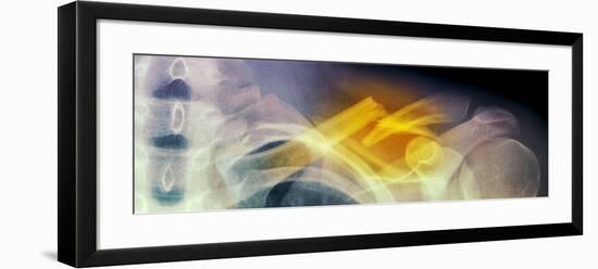 Fractured Collar Bone, X-ray-Du Cane Medical-Framed Photographic Print