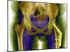 Fractured Femur-Du Cane Medical-Mounted Photographic Print