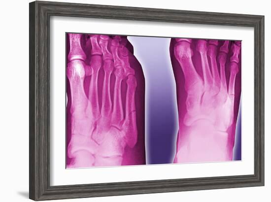 Fractured Foot, Coloured X-ray-Miriam Maslo-Framed Photographic Print