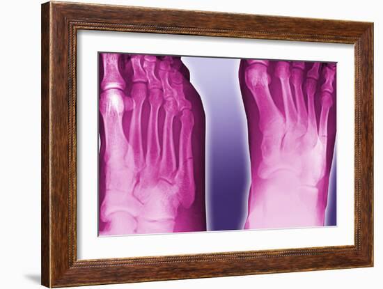 Fractured Foot, Coloured X-ray-Miriam Maslo-Framed Photographic Print