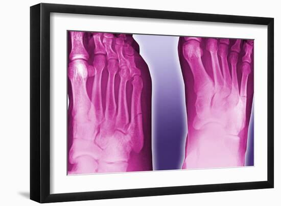 Fractured Foot, Coloured X-ray-Miriam Maslo-Framed Photographic Print