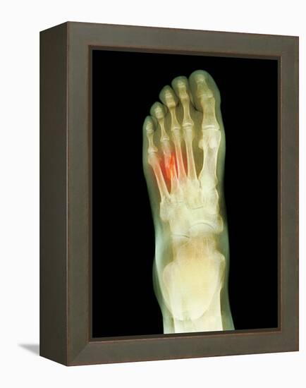 Fractured Foot, X-ray-Du Cane Medical-Framed Premier Image Canvas