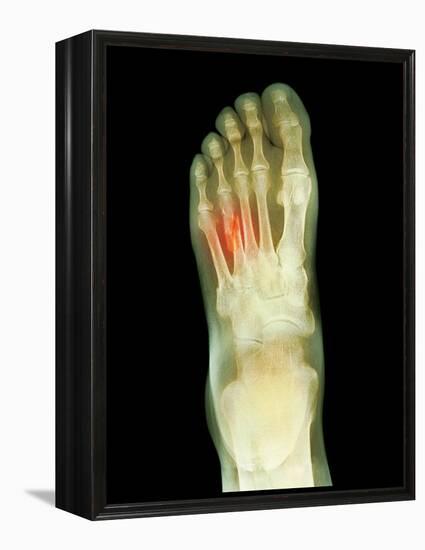 Fractured Foot, X-ray-Du Cane Medical-Framed Premier Image Canvas