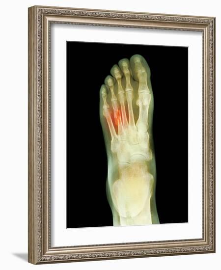 Fractured Foot, X-ray-Du Cane Medical-Framed Photographic Print