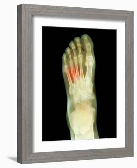 Fractured Foot, X-ray-Du Cane Medical-Framed Photographic Print