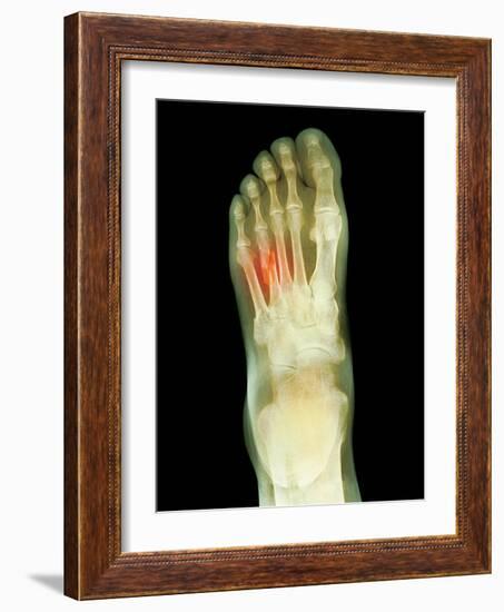 Fractured Foot, X-ray-Du Cane Medical-Framed Photographic Print