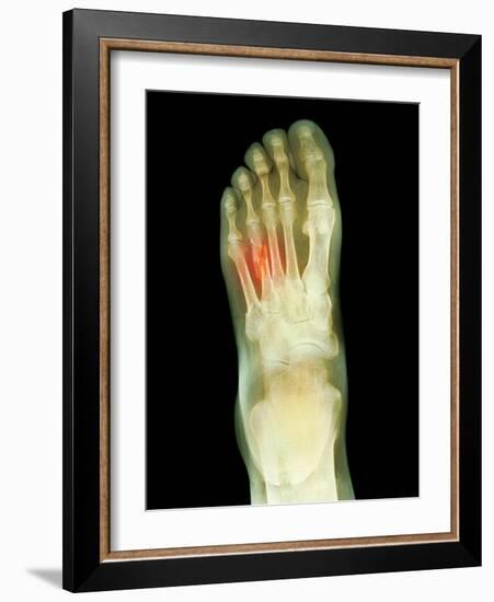 Fractured Foot, X-ray-Du Cane Medical-Framed Photographic Print