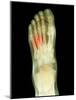 Fractured Foot, X-ray-Du Cane Medical-Mounted Photographic Print