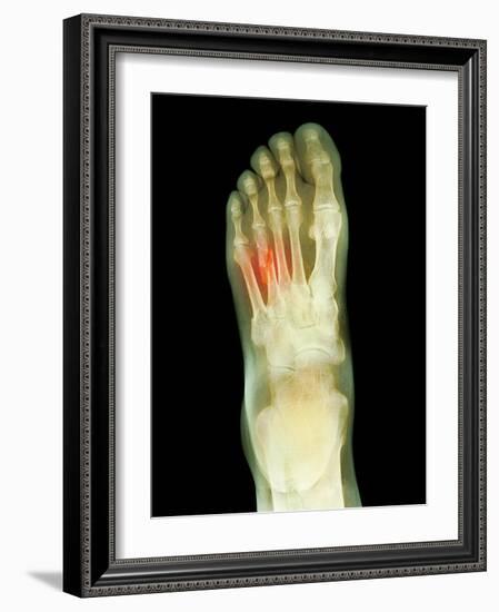 Fractured Foot, X-ray-Du Cane Medical-Framed Photographic Print