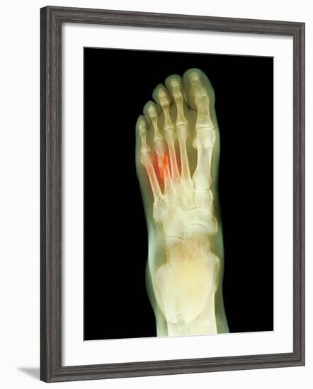 Fractured Foot, X-ray-Du Cane Medical-Framed Photographic Print