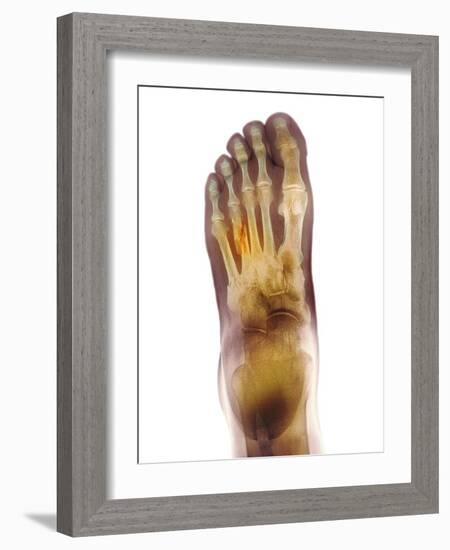 Fractured Foot, X-ray-Du Cane Medical-Framed Photographic Print