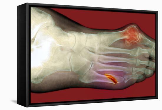 Fractured Foot-Du Cane Medical-Framed Premier Image Canvas