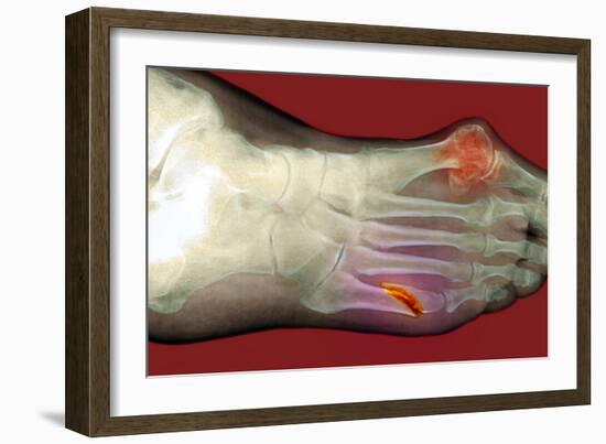 Fractured Foot-Du Cane Medical-Framed Photographic Print