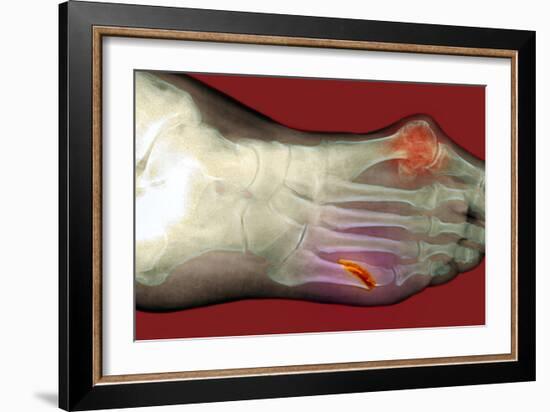 Fractured Foot-Du Cane Medical-Framed Photographic Print