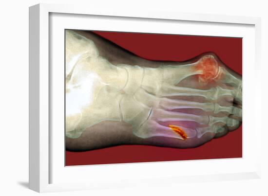 Fractured Foot-Du Cane Medical-Framed Photographic Print