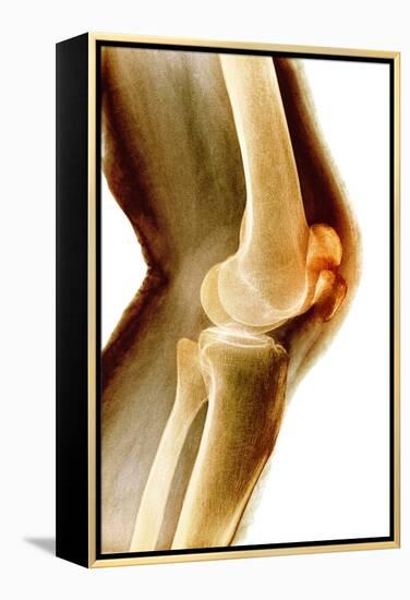 Fractured Kneecap, X-ray-Du Cane Medical-Framed Premier Image Canvas