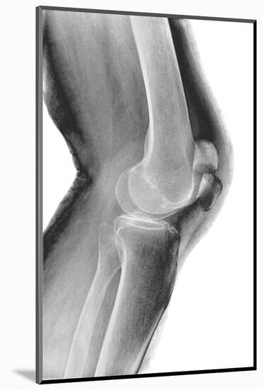 Fractured Kneecap, X-ray-Du Cane Medical-Mounted Photographic Print