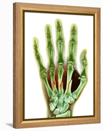 Fractured Palm Bones of Hand, X-ray-Science Photo Library-Framed Premier Image Canvas