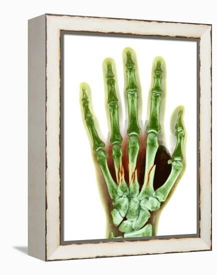 Fractured Palm Bones of Hand, X-ray-Science Photo Library-Framed Premier Image Canvas