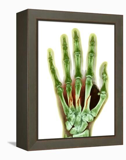 Fractured Palm Bones of Hand, X-ray-Science Photo Library-Framed Premier Image Canvas